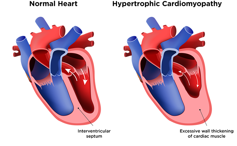 Hypertrophic Cardiomyopathy