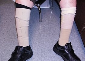 Lymphedema Wrap