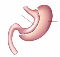 Gastric Sleeve