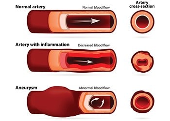 Aortic Aneurysm 