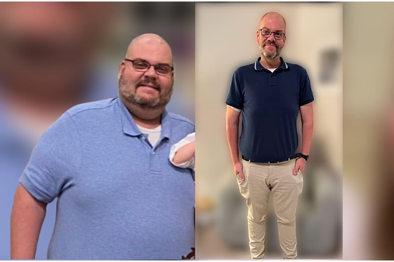 Benjamin Parish Before and After Bariatric Surgery